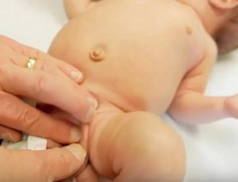 Паховая грыжа у ребенка симптомы. Паховая грыжа у грудничка. пупочная грыжа у новорожденных. врожденная пупочная грыжа. паховая грыжа у новорожденного мальчика.