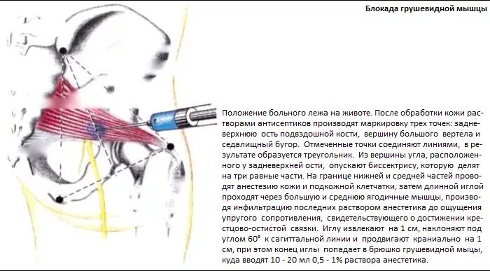 Блокада седалищного нерва отзывы. Грушевидная мышца воспаление блокада. синдром грушевидной мышцы симптомы. симптом грушевидной мышцы блокада. синдром грушевидной мышцы симптомы упражнения.
