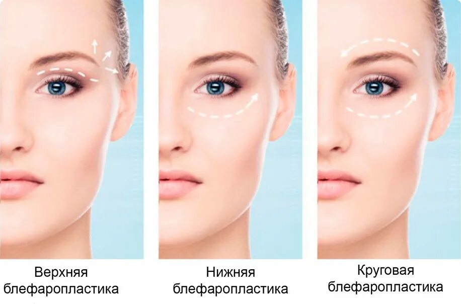 Нависшее веко операция как называется