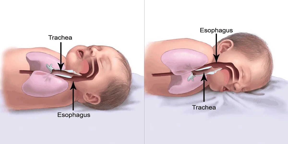 Sudden Infant Death Syndrome. Как класть новорожденного на бок. Как правильно спать новорожденному ребенку.