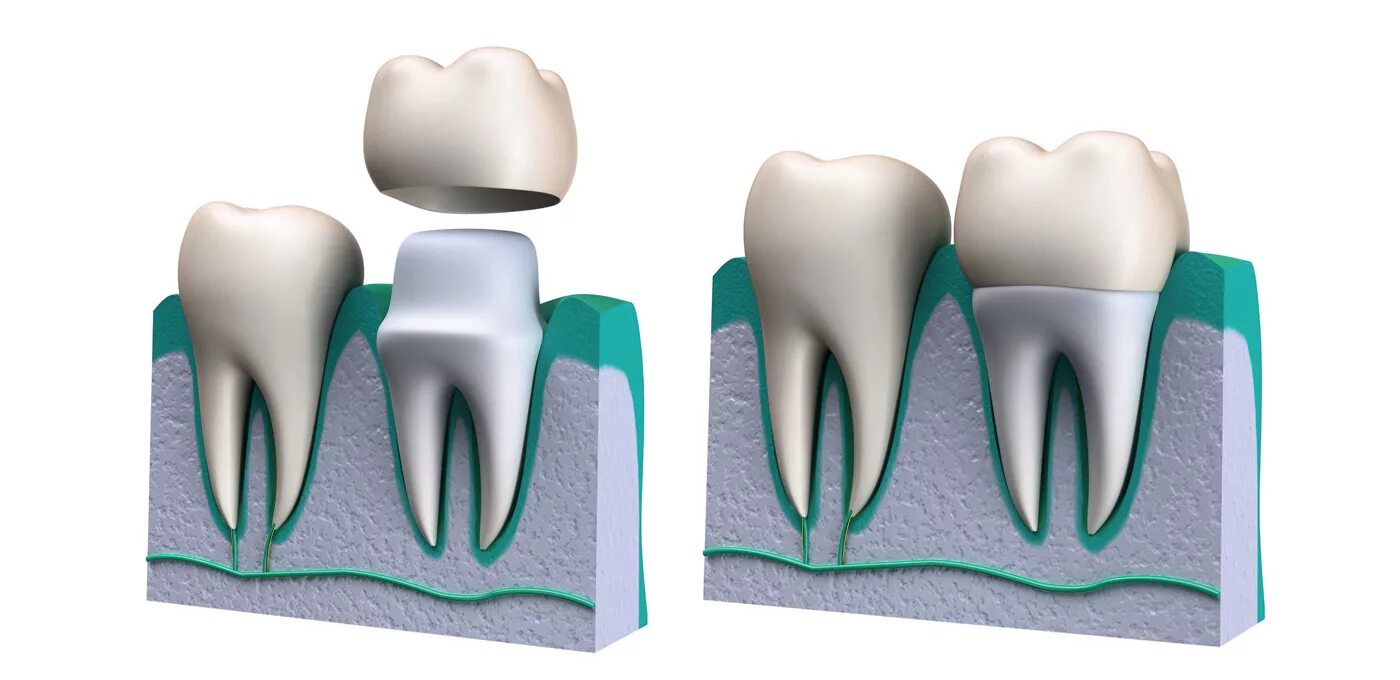 Почему ставят коронки. Стоматологические коронки. Разрушение коронки зуба.