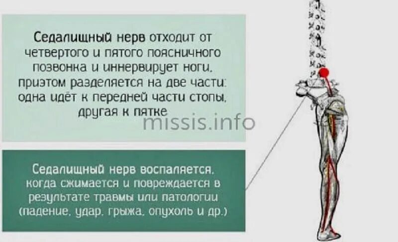 Седалищный нерв симптомы. Воспаление и защемление седалищного нерва. Седалищный нерв защемление симпт. Симптомы пережатия седалищного нерва.