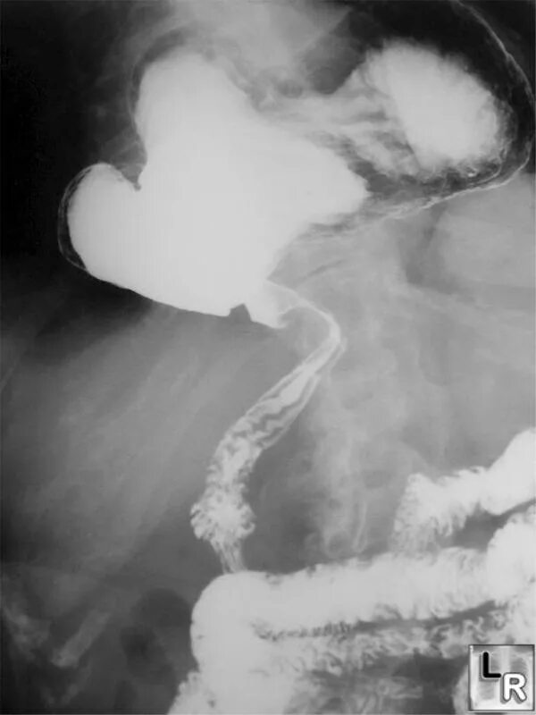 рентгенография диафрагмальная грыжа. рентгеноскопия желудка гпод. грыжа пищеводного отверстия диафрагмы рентген. рентген желудка грыжа. диафрагмальная грыжа желудка рентген.