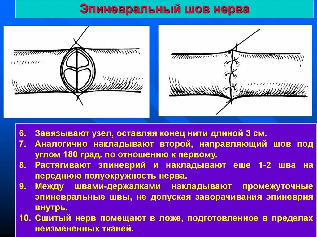 Сшивание нерва латынь. Принципы наложения шва нерва. Эпиневральный и периневральный шов. Методика сшивания нерва. Эпиневральный шов нерва.