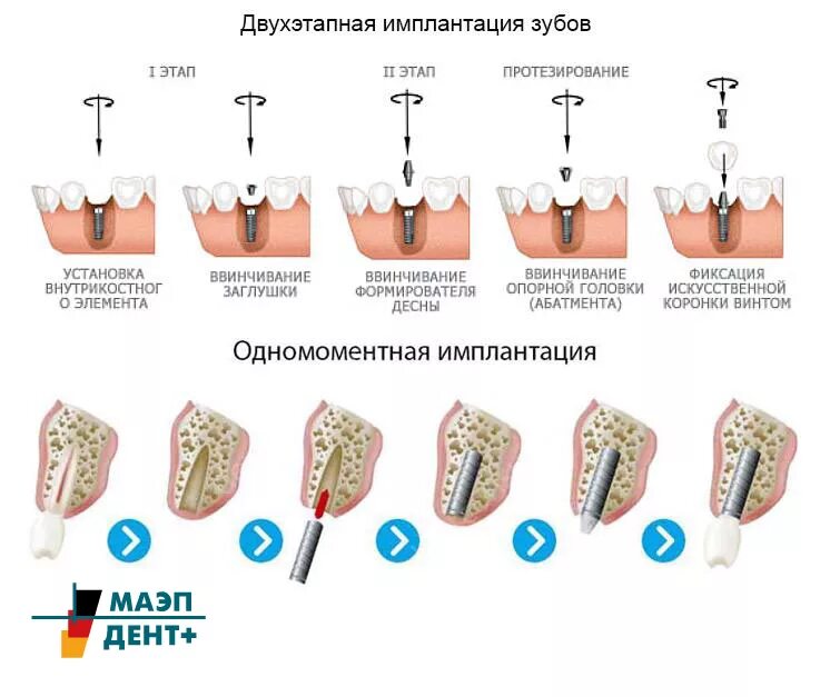 Выплата за протезирование