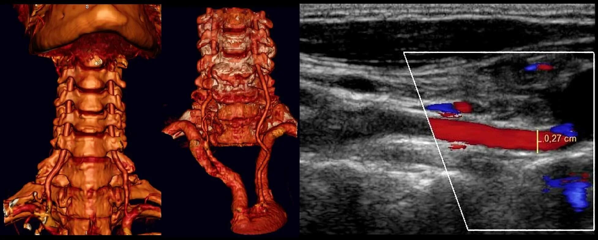 Ультразвуковая допплерография сосудов шеи. УЗИ сосудов шеи доплер. УЗДГ сосудов шеи артерии. Допплеровское сканирование сосудов шеи. Бцс что это за обследование