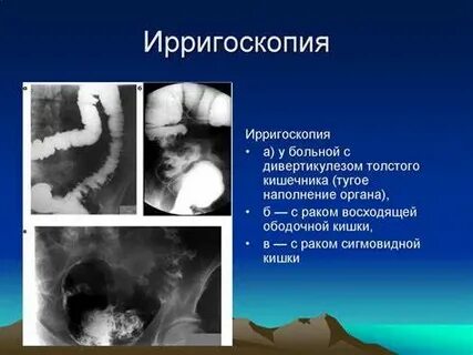 Ирригоскопия кишечника подготовка к исследованию