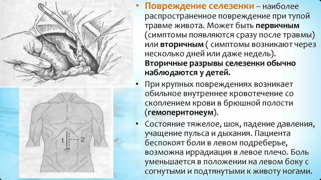 После операции селезенки. Разрыв селезенки симптомы хирургия. Повреждение селезенки симптомы. Травма селезенки симптомы.