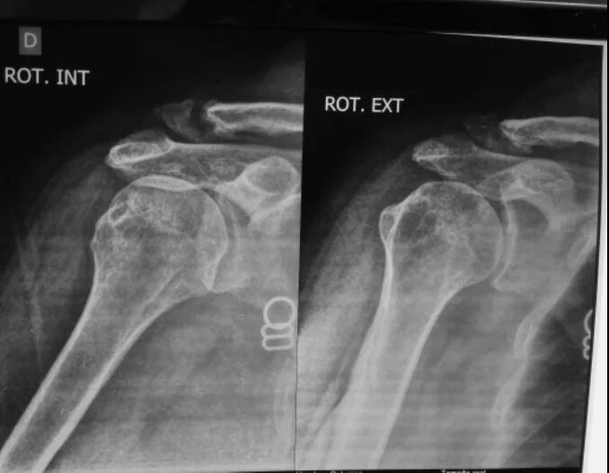 ложный сустав при переломе ключицы. ложный сустав ключицы. ложный сустав ключицы рентген. остеосинтез ключицы ложный сустав. ложный сустав ключицы.