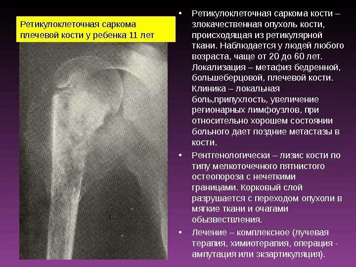 Саркома юинга у детей. Саркома Юинга плечевой кости рентген. Остеосаркома плечевой кости рентген. Саркома Эвинга плечевой кости рентген. Симптомы остеосаркомы бедренной кости.