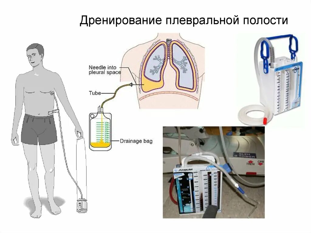 Дренажная система для плевральной полости BPDS-2000 мл. Плевральный дренаж Бюлау. Схема активной аспирации из плевральной полости. Система для дренирования плевральной полости по Петрову-Бюлау.