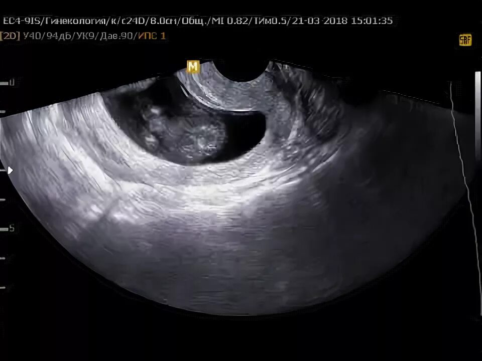 Матка после медикаментозного прерывания. УЗИ после медикаментозного прерывания беременности. Плодное яйцо на 10 неделе беременности. Замершая беременность УЗИ. Неразвивающаяся беременность и выкидыш.
