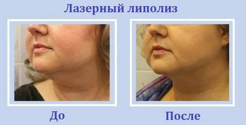 Лазерный липолиз до и после отзывы Лазерная Липосакция Отзывы Фото До И После