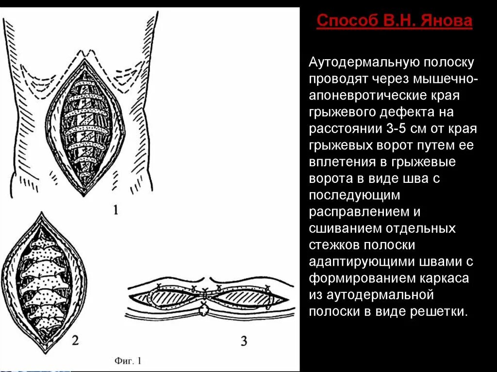 Операция янов. Способ янова. мышечно-апоневротические образования..