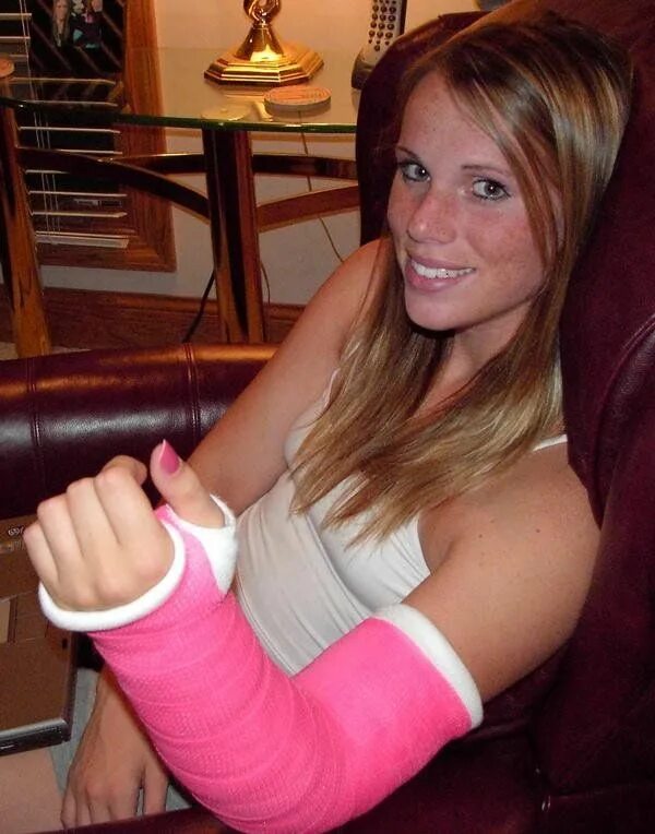 Arm casting. Arm cast women. broken arm women. jm girl 280.