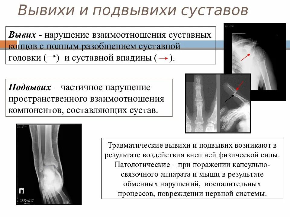 Вывихи. Вывих коленного сустава классификация. Вывих большеберцовой кости в коленном суставе. Виды вывихов суставов. Вывих коленного сустава классификация.