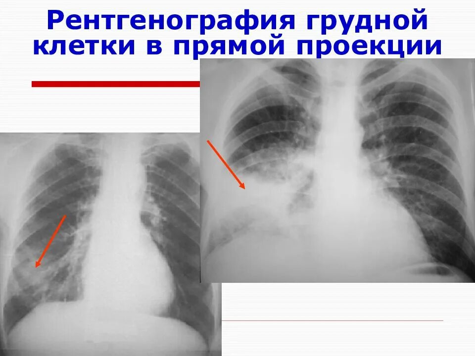Снимок в прямой проекции. Рентгенограмма грудной клетки пневмония. пневмония рентген боковая проекция. рентгенография грудной клетки (в 1-й проекции). рентгенография грудной клетки в прямой проекции.