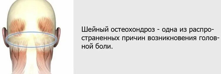 При головной боли. Головная боль при остеохондрозе. Боль в затылке при остеохондрозе. Боит голлва при остеохондроз. Тянет лоб