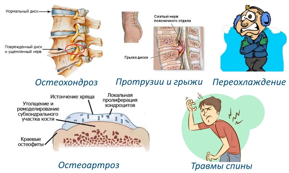 Синдромы остеохондроза поясничного отдела. Вертеброгенная люмбоишиалгия. Клиническая картина остеохондроза. Хроническая вертеброгенная люмбоишиалгия. Вертеброгенный синдром люмбалгии.