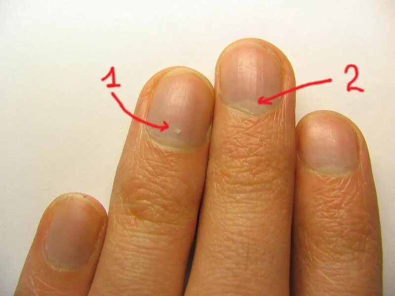 Белые ногти пальцев рук приметы. Лейконихия белые пятна на ногтях. Белые ногти пальцев рук приметы. Белые отметины на ногтях. Белые ногти пальцев рук приметы.