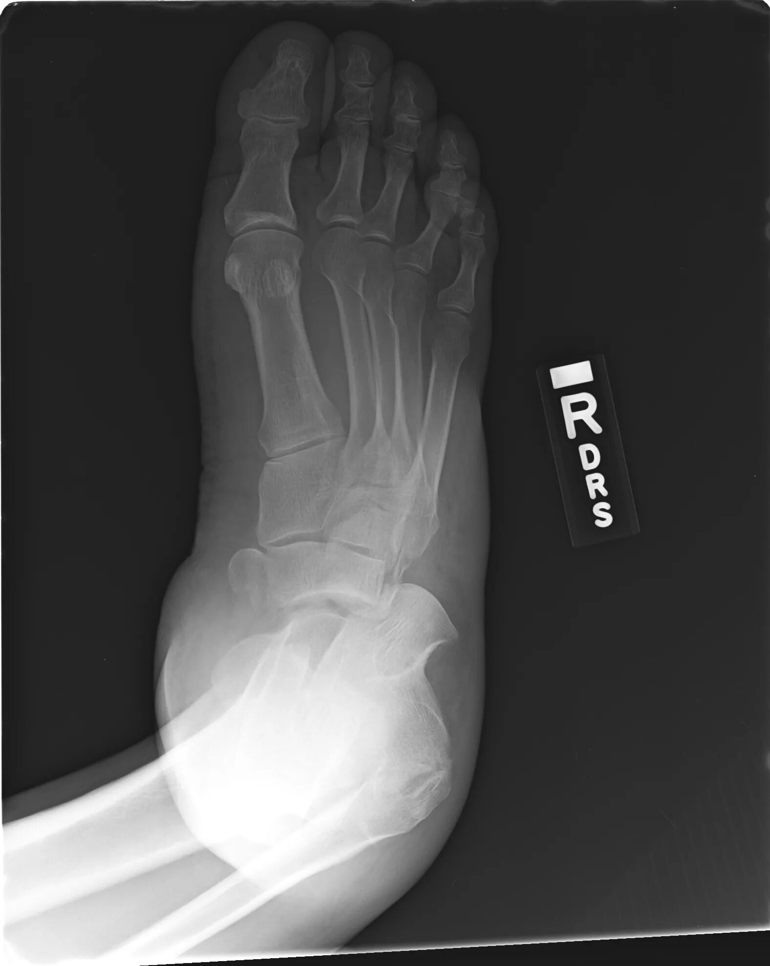 Breaking fracture. Breaking fracture. Metacarpal. Breaking fracture. Спиральная кость.