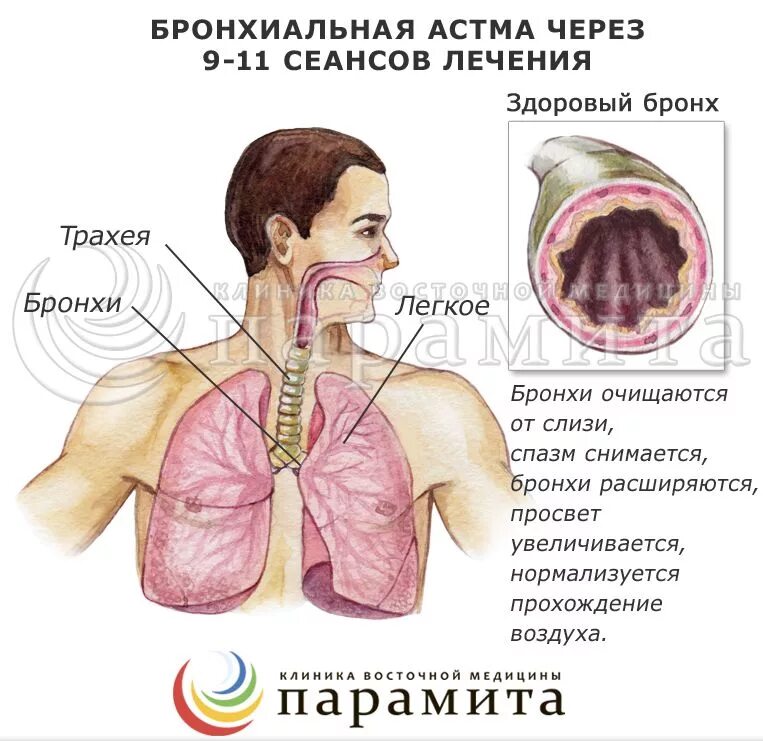 Бронхиальная астма. Бронхиальная астма удушье. Бронхиальная астма легкие.