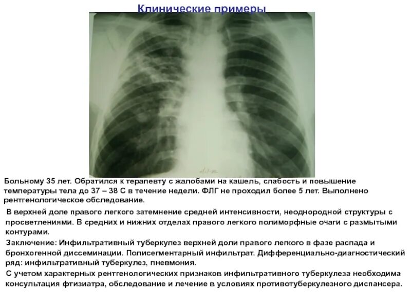 Жалобы на повышение температуры тела. Инфильтративный туберкулез жалобы. Инфильтративный туберкулез аускультация. Жалобы пациента при туберкулезе. Кашель при туберкулезе легких.