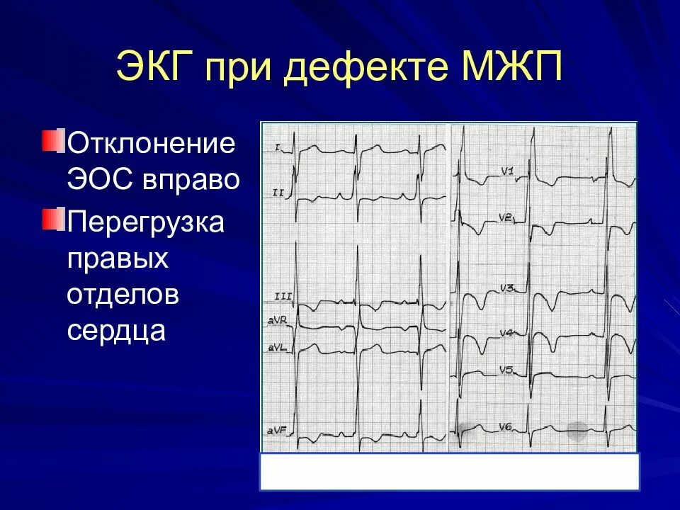 Дефект межжелудочковой перегородки ЭКГ. Гипертрофия межжелудочковой перегородки на ЭКГ. Дефект межпредсердной перегородки ЭКГ. ЭКГ при дефекте межжелудочковой перегородки. Перегрузка на экг что это