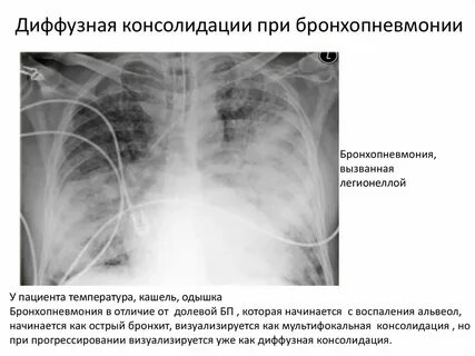 Консолидация легочной ткани на кт