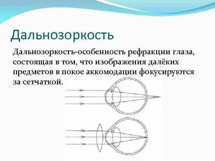 Установите соответствие изображение фокусируется перед сетчаткой