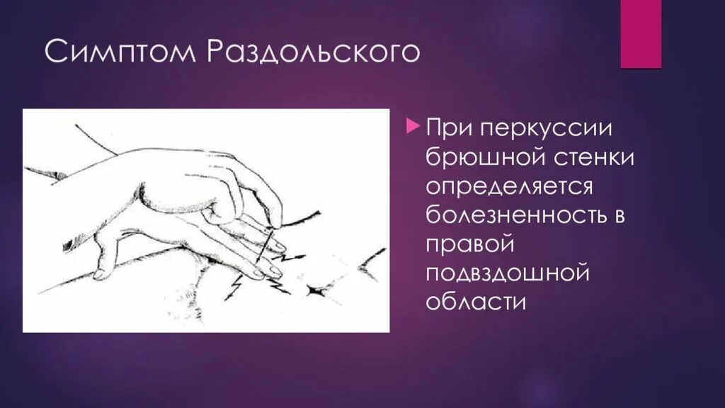 Симптомы Раздольского аппендицит. Положительный симптом Раздольского. Перкуссия при аппендиците.