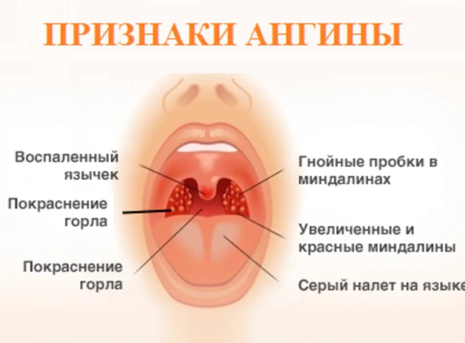 Горловое лечение. Ангина лакунарная катаральная.