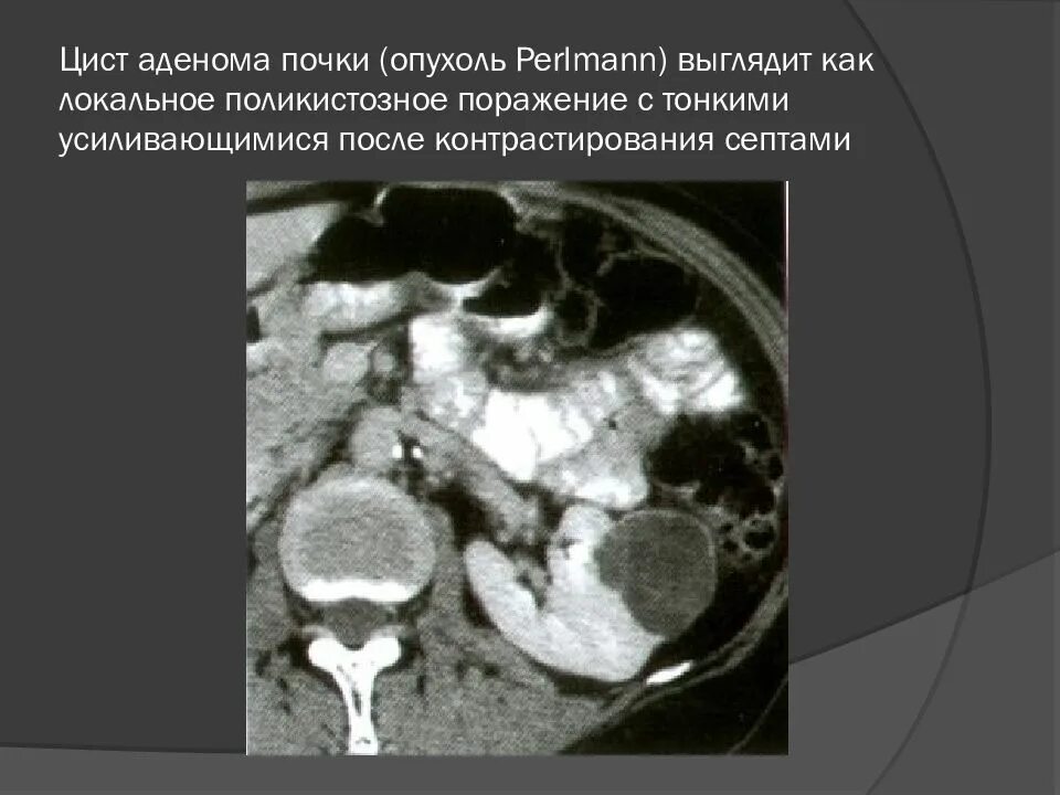 Темноклеточная (базофильная) аденома почки. Папиллярная аденома почки. Контрастирования аденома почки на кт. Локальное опухоль