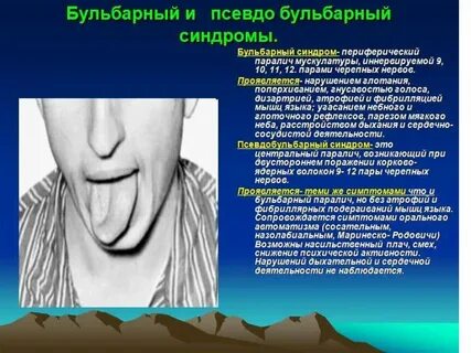 Язык после инсульта