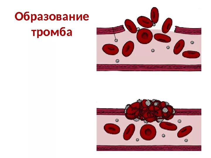 Как называется образование тромба. Образование кровяного сгустка схема. схема образования тромба. образование тромба рисунок.