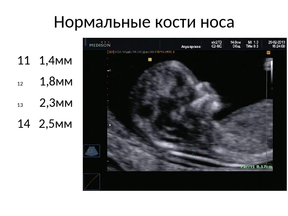 Носовая кость УЗИ плода в 12 недель норма. Носовая кость в 12 недель при синдроме Дауна. 13 Недель беременности носовая кость 1,5 мм. Носовая кость плода в 20 недель на УЗИ. Кости в 13 недель