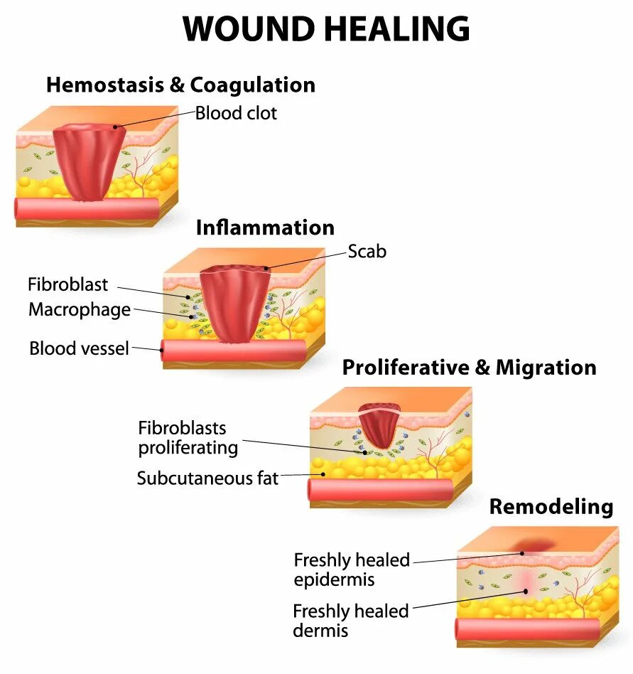 Wound process. Platelets growth factors. Acute wound chronic wound pathophysiology. Wound process. Skin wound healing mechanism.