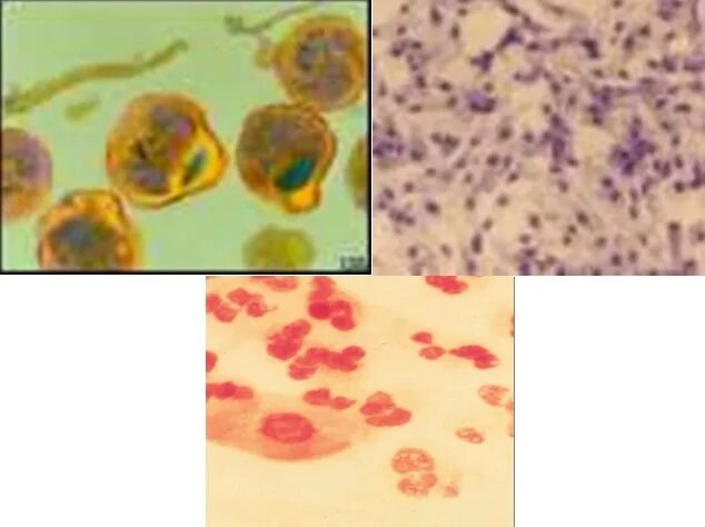 Anti chlamydia trachomatis. Язвы, вызванные хламидией трахоматис. Хламидия трахоматис симптомы. Хламидии трахоматис у женщин.