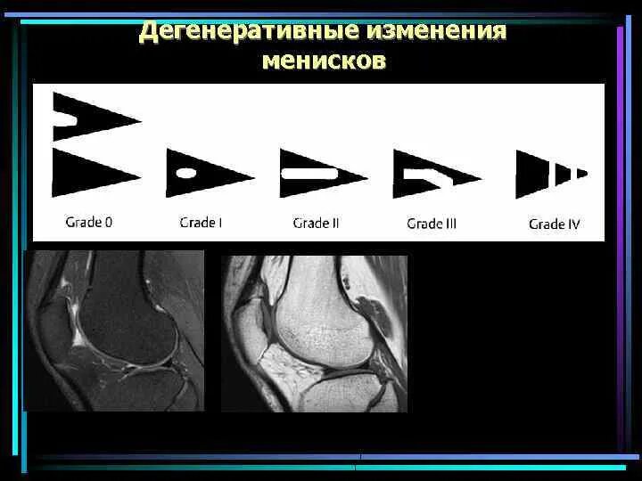 Повреждение мениска коленного сустава по stoller. Центральная дегенерация медиального мениска 2 степени по Stoller. Степени повреждения мениска по Stoller. Дегенеративные изменения латерального мениска 2 ст по Stoller. Дегенеративные изменения менисков 1-2 степени по Stoller.