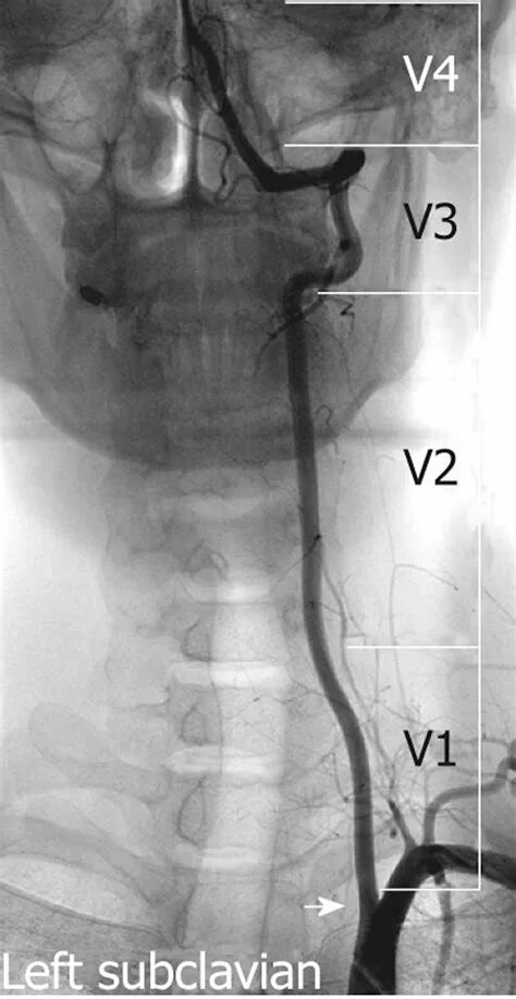 Сегмент v 4. Сегмент v1 позвоночной артерии. Сегмент v 4. V4 сегмент позвоночной артерии. Аплазия позвоночной артерии.