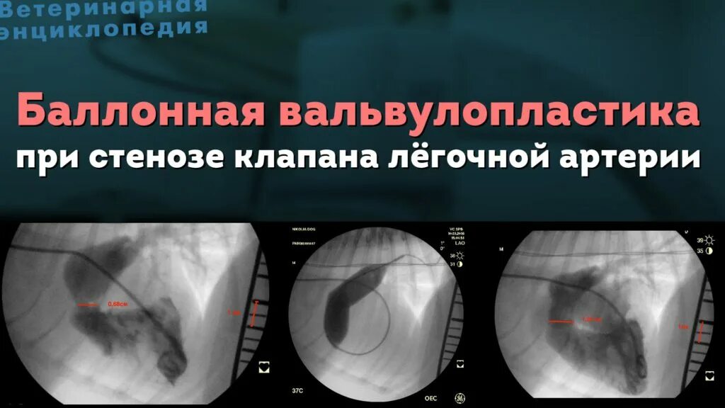 При каком стенозе делают операцию