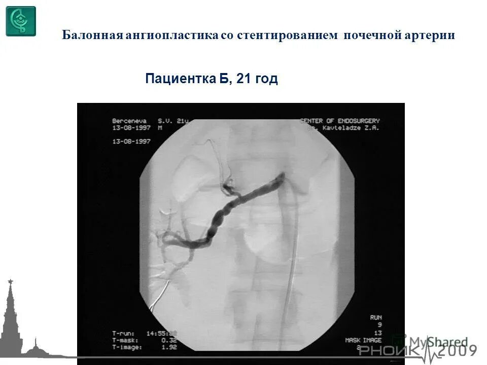 Транслюминальная ангиопластика почечной артерии. Баллонная ангиопластика сосудов почки. Стентирование почечной вены. Стентирование почечной артерии. Баллонная ангиопластика сосудов почки.