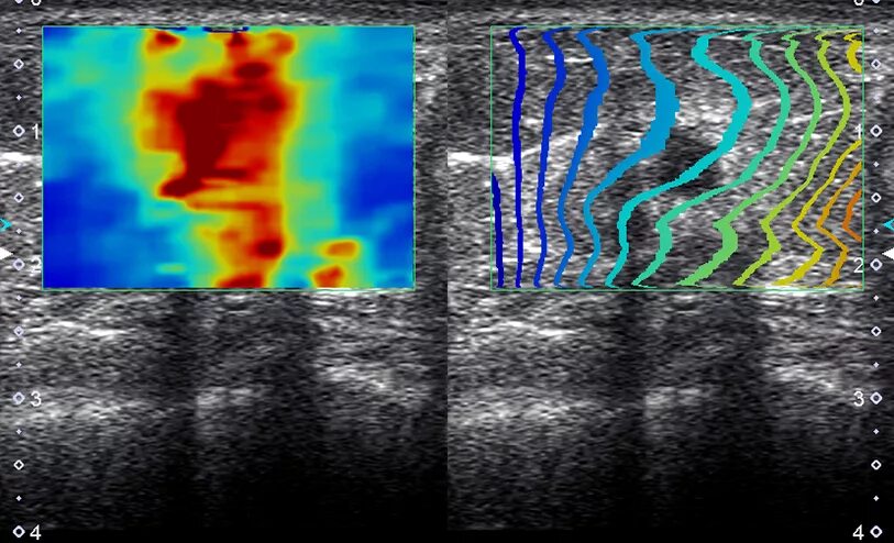 Эластография щитовидной железы что это. Эластография Canon Aplio. Эластография сдвиговой волны. Ультразвуковая эластография молочной железы. Компрессионная эластография молочных желез.
