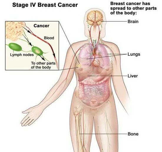 Vla4 Cancer. Breast Cancer 4 Stage statistics. Test and Soft breast Cancer. Stages of cancer