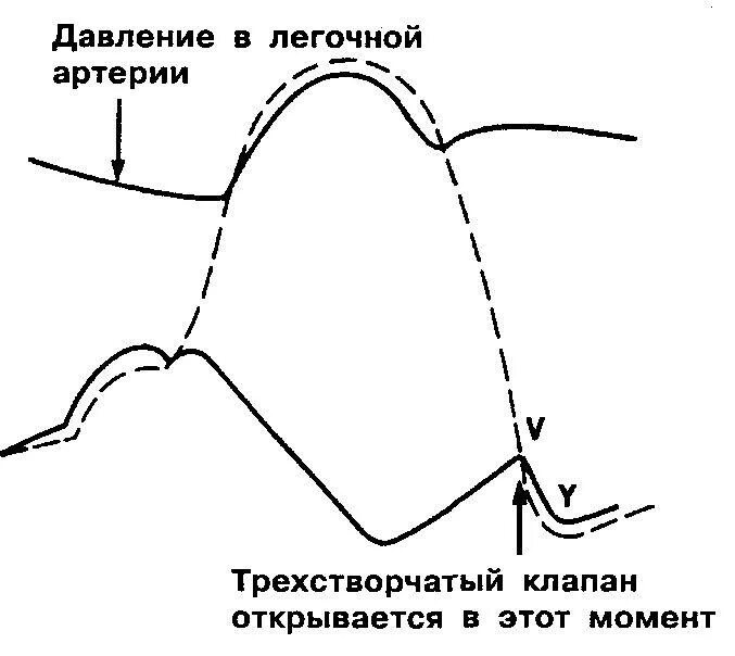 Давление в правом предсердии. Давление в легочной артерии. Давление в легочной артерии формула. Давление в легочной артерии норма. Мониторинг давление в легочной артерии.