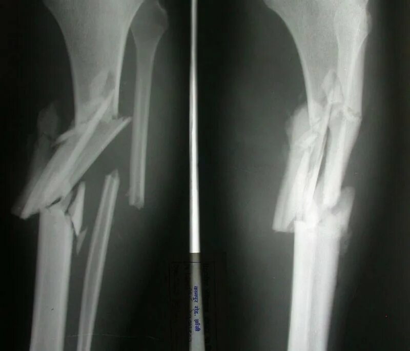Открытая трещина. Перелом костей голени рентген. Рентгенограмма перелом кости. Многооскольчатый перелом рентген. Переломы трубчатых костей рентген.