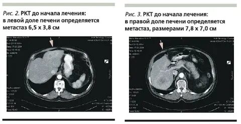 Метастазы в печени при раке желудка