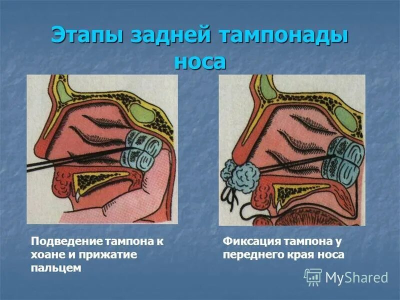 Остановка носового кровотечения задняя тампонада. Остановка носового кровотечения передняя тампонада. Передняя и задняя тампонада носа.