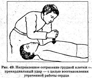 Нанесение прекардиального удара в область грудины