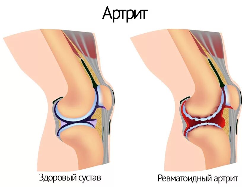 Ревматическое поражение суставов